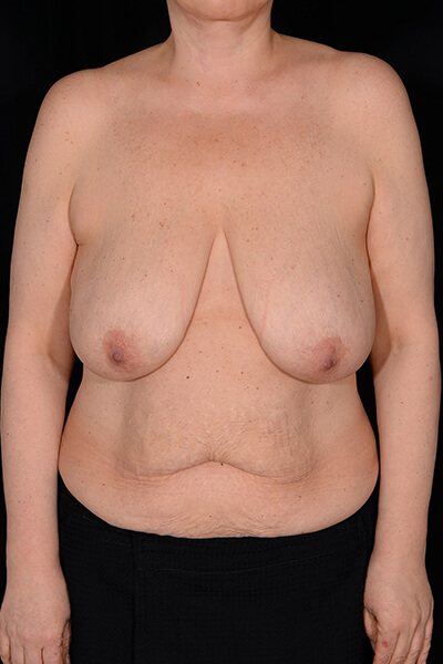 Breast lift before image.