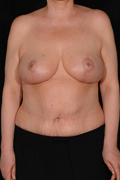 Breast lift after image.