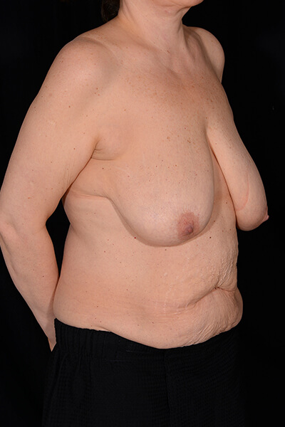 Breast lift before image.