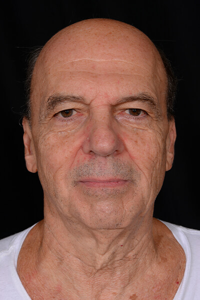 Mini facelift and blepharoplasty before image.