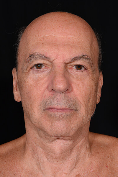 Mini facelift and blepharoplasty after image.