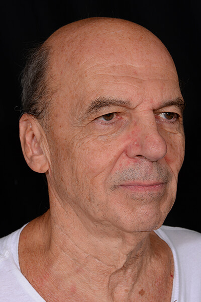 Mini facelift and blepharoplasty before image.