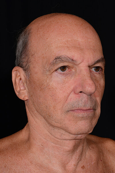 Mini facelift and blepharoplasty after image.