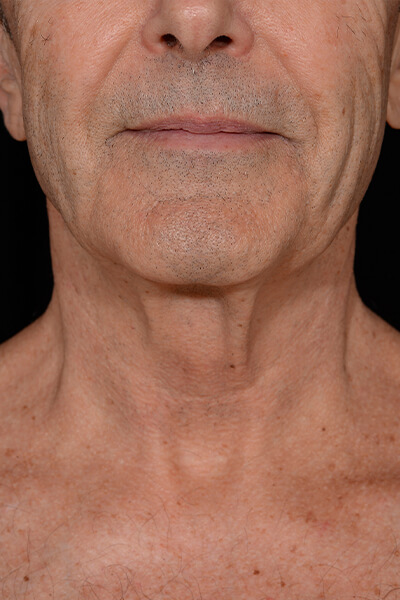 Neck lift before image.