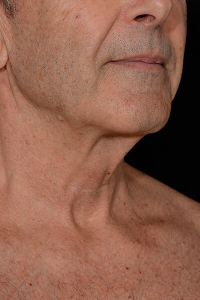 Neck lift before image.