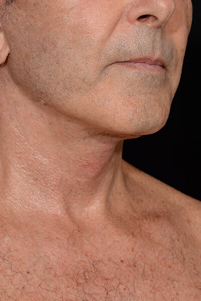 Neck lift after image.