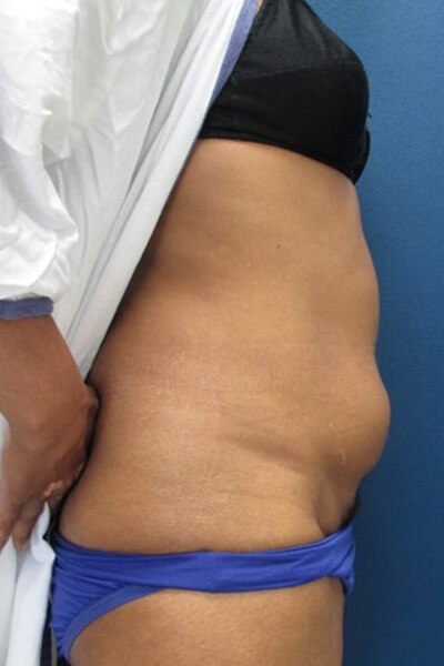 Tummy tuck before image.