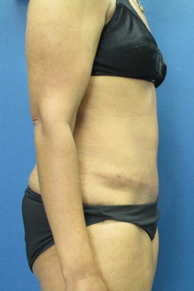 Tummy tuck after image.
